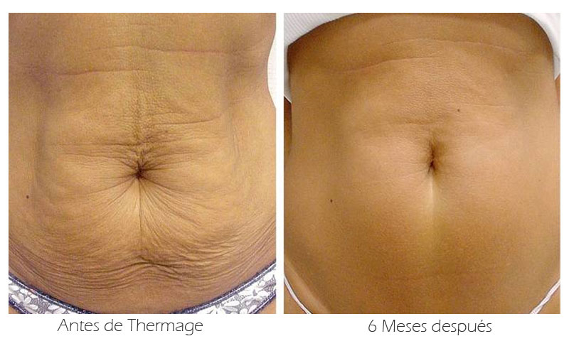 Antes y después de un Thermage para la flacidez del abdomen