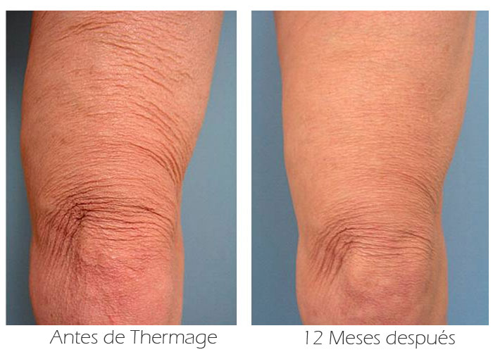 Antes y después de un Thermage para la flacidez de las piernas