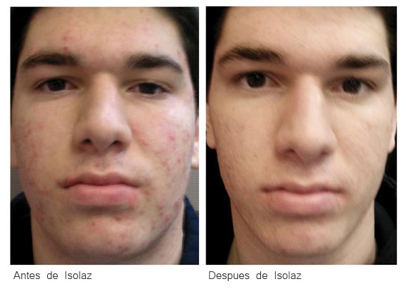 Antes y Después del tratamiento con ISOLAZ