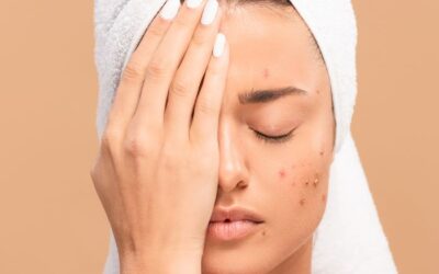 Tratamientos para el acné: que funciona y que no