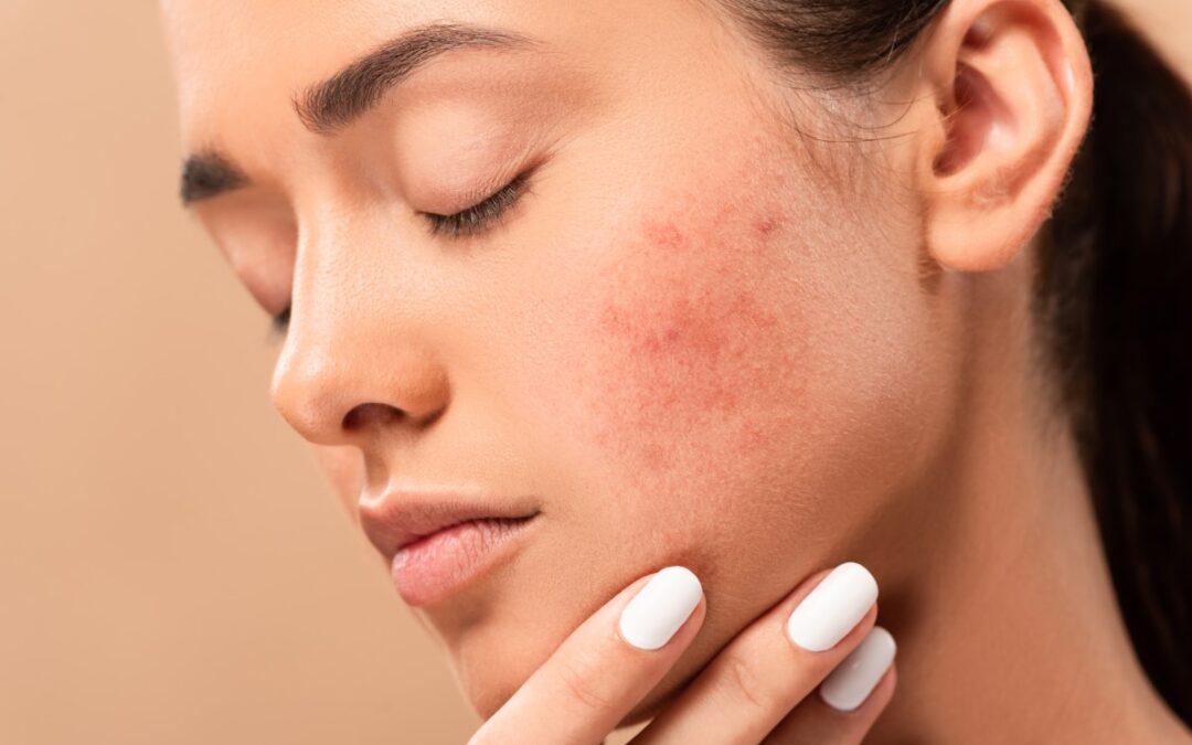 Tipos de acné: conoce sus características y cómo tratarlo