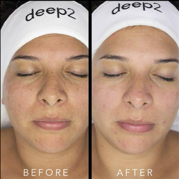 deep2 tratamiento facial