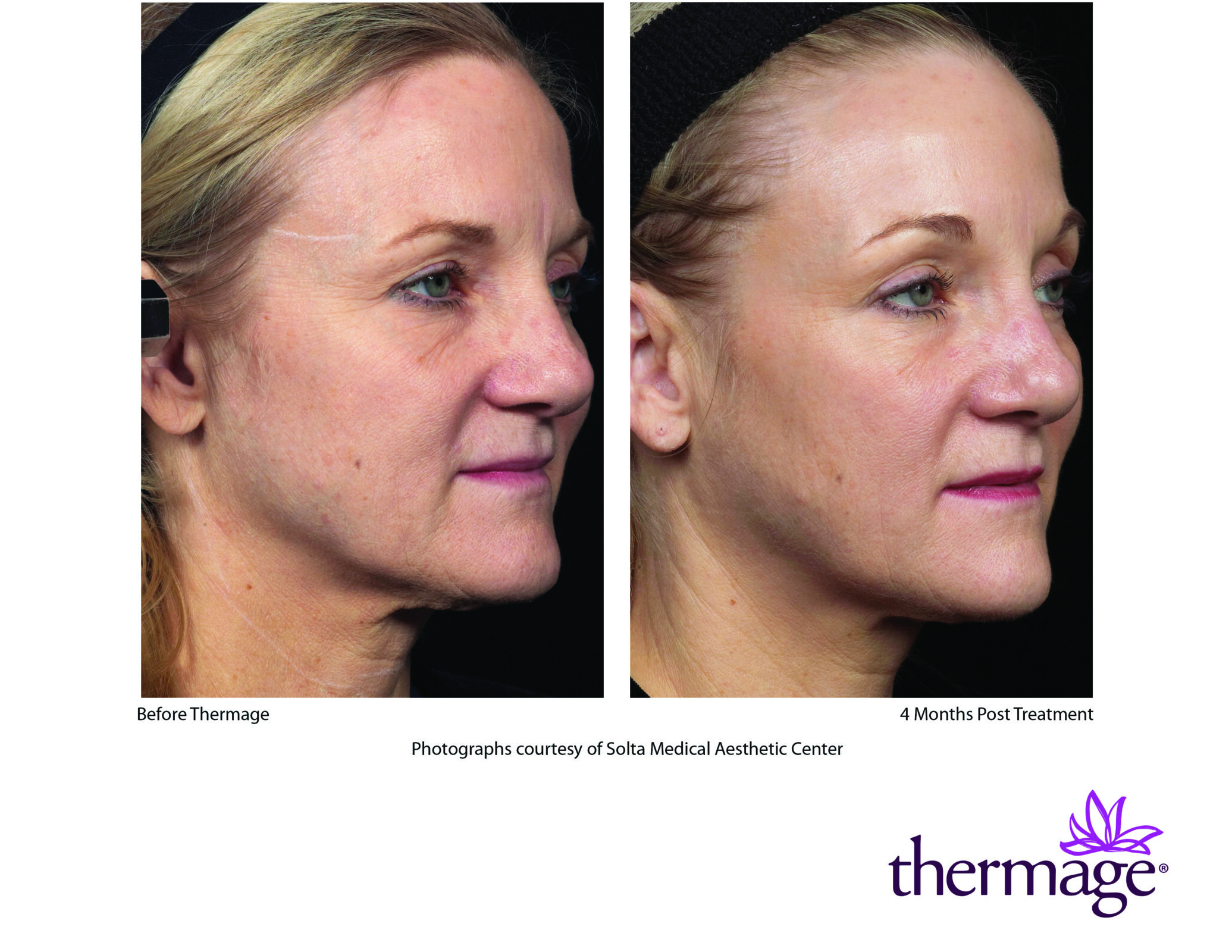 Thermage, sin tiempo de inactividad